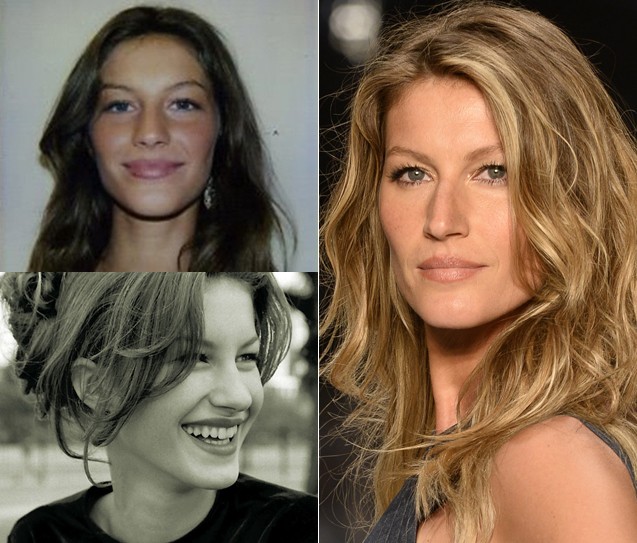 Gisele Bundchen Rinoplastia